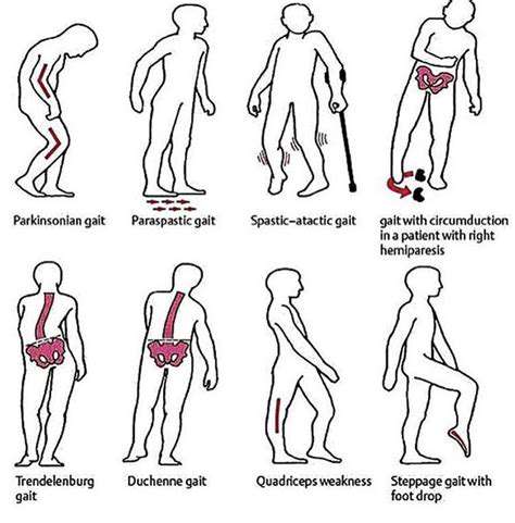 ImprovedPostureandGait