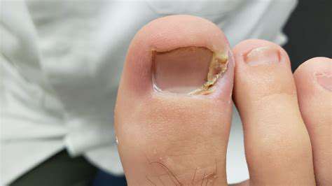 IngrownToenails:ACommonFootProblemRequiringCare