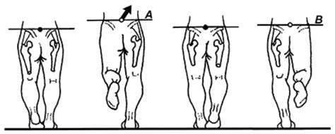 Addressing Leg Length Discrepancy​