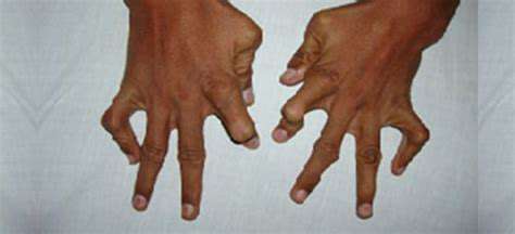 GeneticPredispositionandPotentialHandDeformities