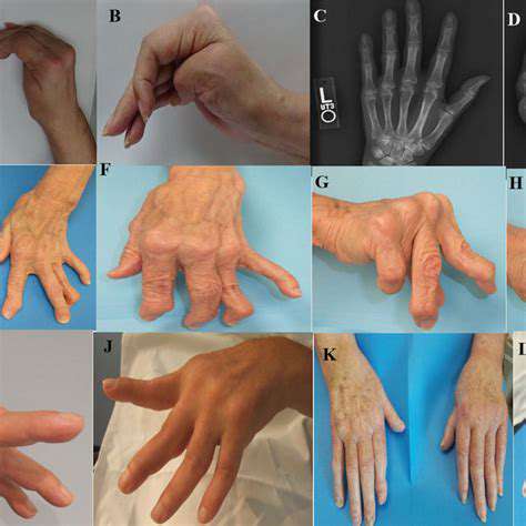 The Role of Genetics in Hand Disorders